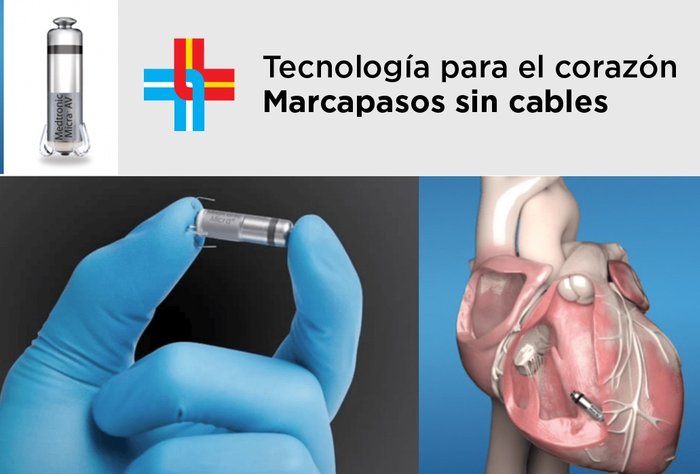 Tecnología para el corazón: marcapasos sin cables